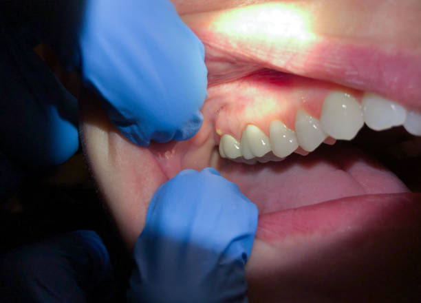 Best Chipped Tooth Repair Near Me  in Emerson, NJ